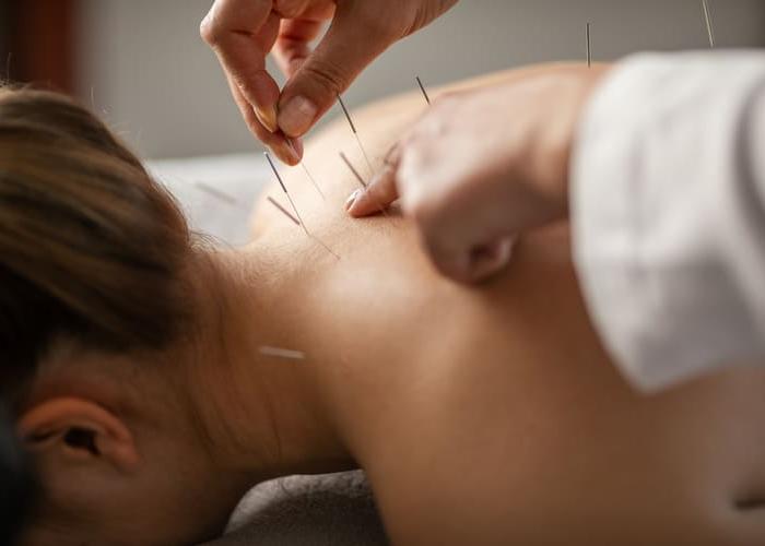 A young woman getting an acupuncture treatment on her back. She is lying face down on the bed.