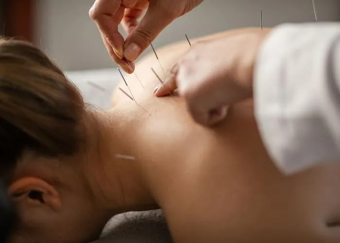 A young woman getting an acupuncture treatment on her back. She is lying face down on the bed.